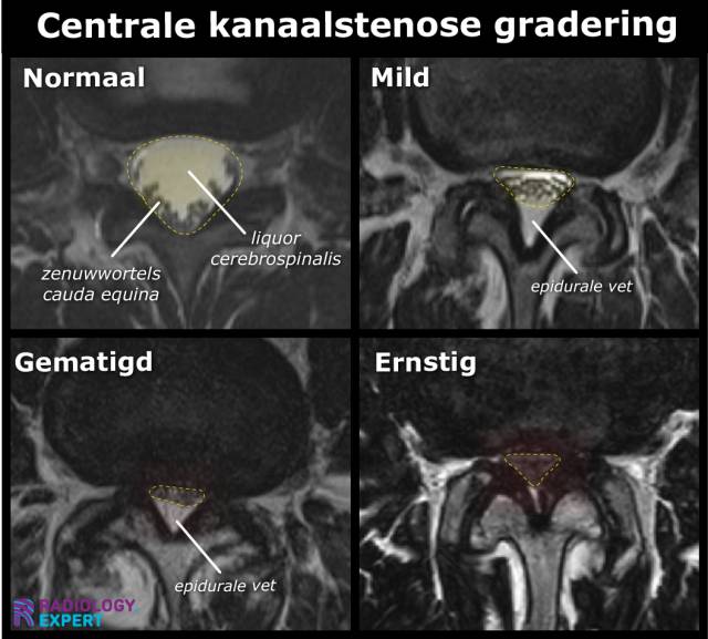 Mri Lumbale Wervelkolom 3496